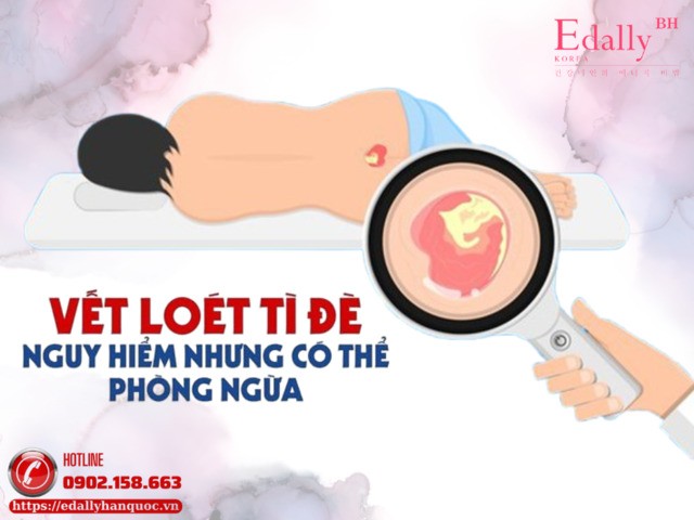 Vết Loét Da Tì Đè - Biến Chứng Nguy Hiểm Cần Phòng Ngừa Và Điều Trị Kịp Thời