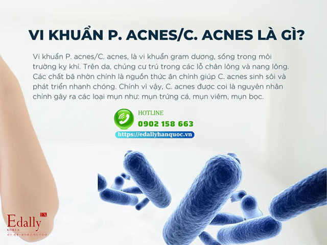 Vi khuẩn gây mụn P.acnes/ C.acnes là gì?