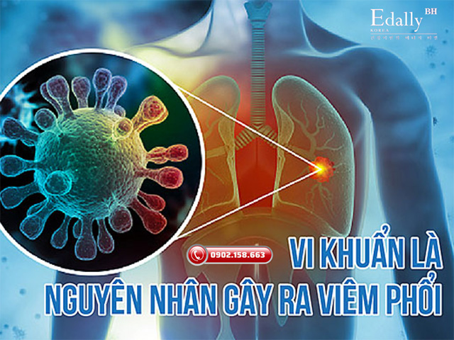 Vi khuẩn là nguyên nhân gây ra bệnh viêm phổi khi giao mùa