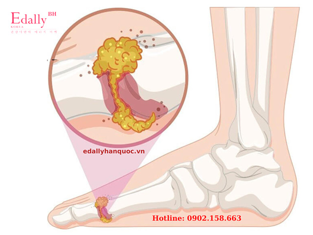 Tại sao bệnh gout hay bị viêm ở các khớp bàn chân?