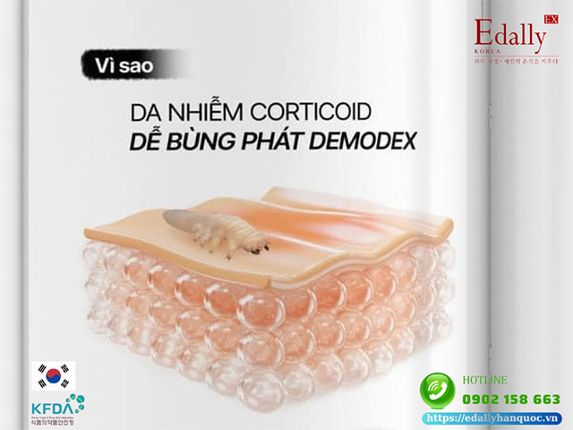 Tại sao da nhiễm corticoid dễ bùng phát demodex?