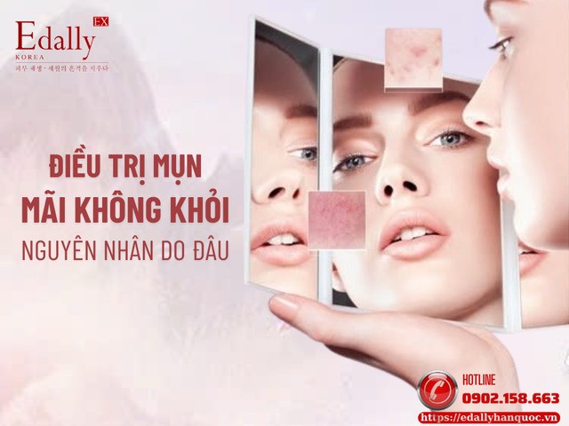 Vì sao bạn điều trị mụn mãi không khỏi