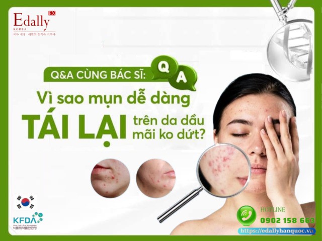 Vì sao mụn trứng cá cứ tái đi tái lại trên da dầu mãi không dứt?