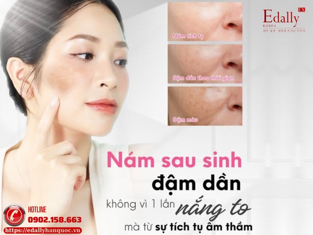 Nám sau sinh đậm dần lên không vì 1 lần nắng to mà là sự tích tụ âm thầm Nám sau sinh đậm dần lên không vì 1 lần nắng to mà là sự tích tụ âm thầm