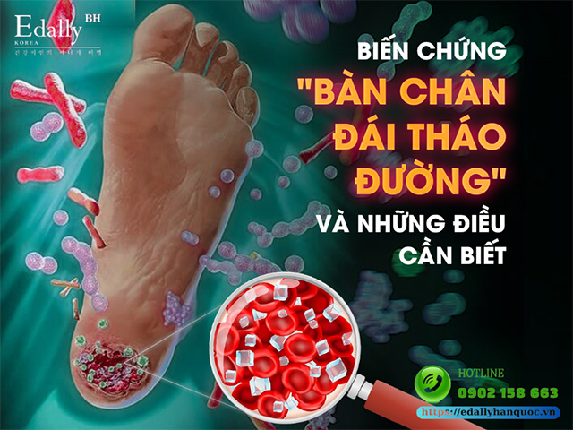 Tại sao người bệnh tiểu đường dễ bị loét bàn chân?