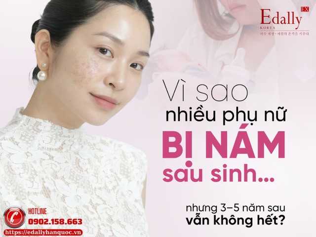 Vì sao rất nhiều phụ nữ bị nám sau sinh nhưng 3-5 năm sau vẫn không hết? Vì sao rất nhiều phụ nữ bị nám sau sinh nhưng 3-5 năm sau vẫn không hết?