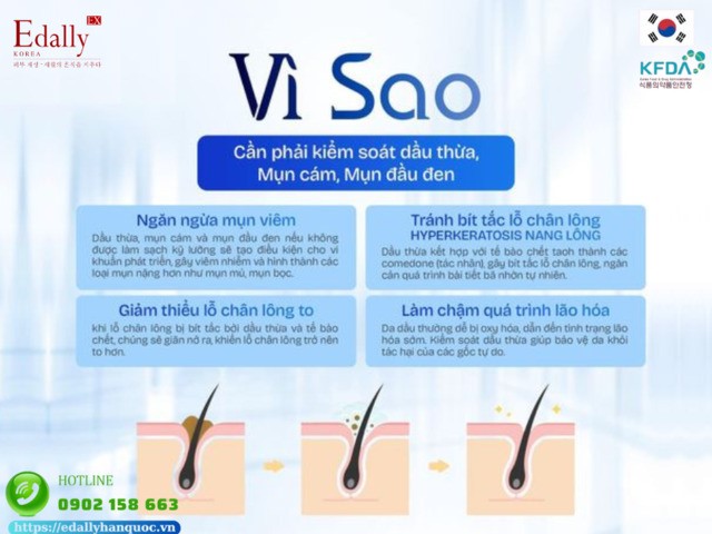 Vì Sao Cần Phải Kiểm Soát Dầu Thừa, Mụn Cám, Mụn Đầu Đen Trên Da?