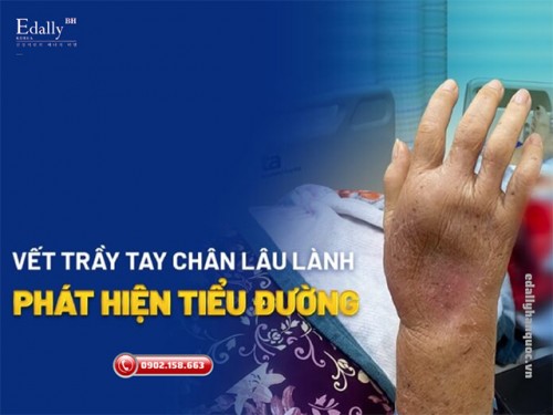 Cách Cầm Máu Và Chăm Sóc Vết Thương Cho Người Bị Tiểu Đường