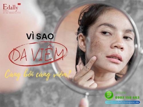 Vì Sao Viêm Da Càng Bôi Lại Càng Viêm?