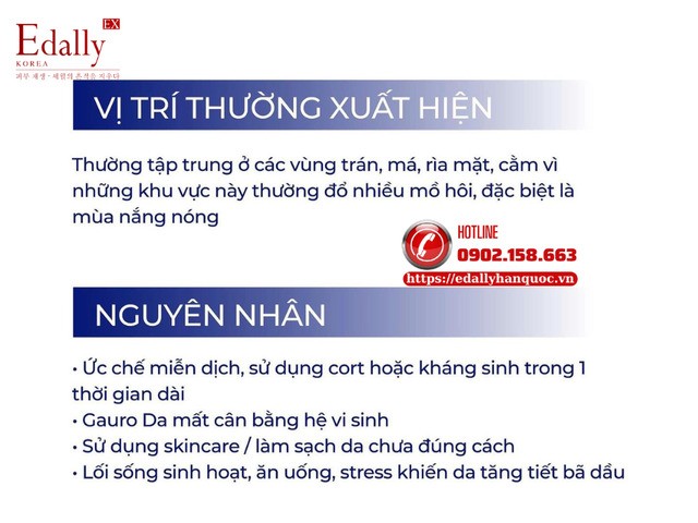 Vị trí xuất hiện của Fungal acne - Da nhiễm nấm men, viêm da tiết bã, viêm nang lông trên da