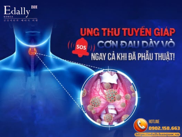 Vi ung thư tuyến giáp thể nhú: trường hơp nào có thể không cần mổ và theo dõi như thế nào?