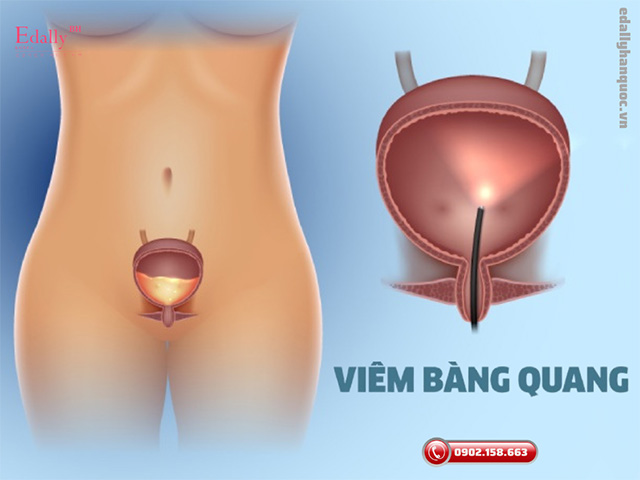 Những điều cần biết về viêm bàng quang để phòng ngừa biến chứng