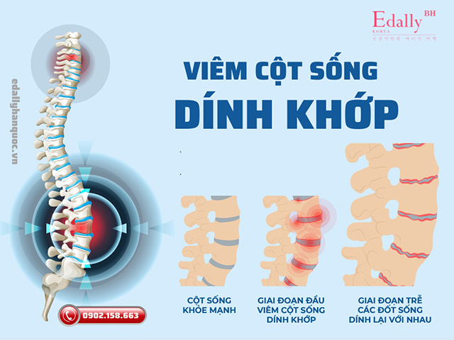 Bệnh viêm cột sống dính khớp có ảnh hưởng gì không?