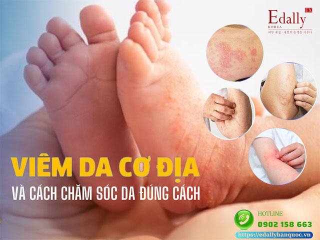 Viêm da cơ địa và cách chăm sóc da đúng cách