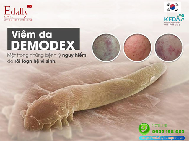 Viêm da do demodex là một trong những bệnh lý do rối loạn hệ vi sinh tren da