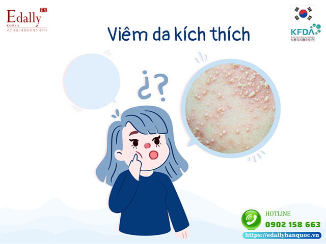 Dấu hiệu viêm da kích thích do nhiễm độc Corticoid