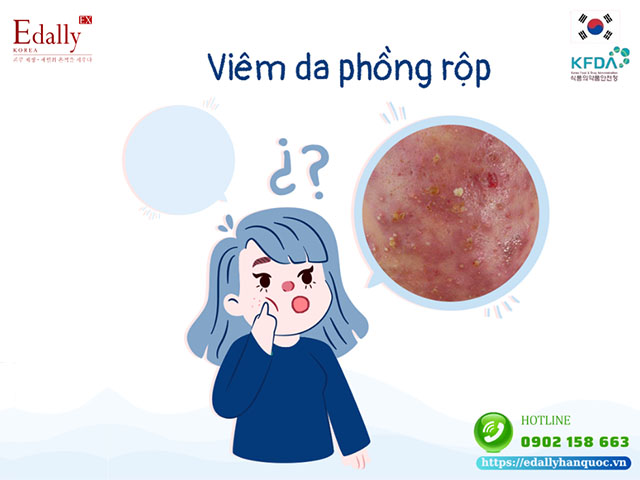 Dấu hiệu viêm da phồng rộp do nhiễm độc Corticoid