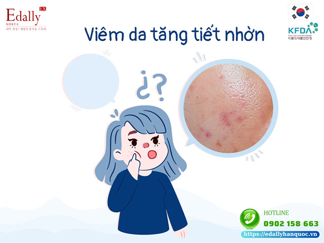 Dấu hiệu viêm da tăng tiết nhờn do nhiễm độc Corticoid