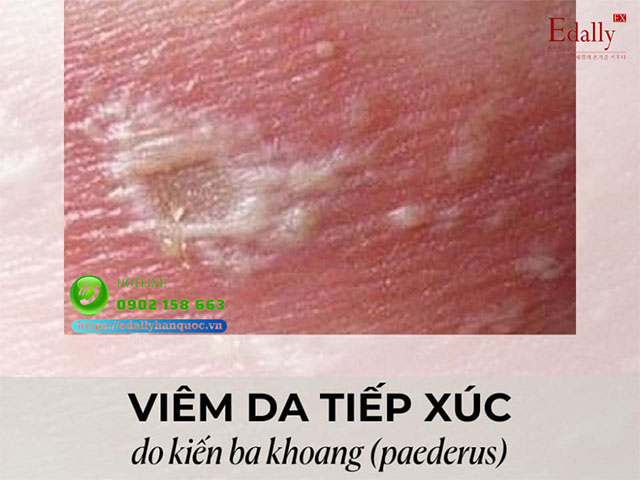 Bệnh viêm da tiếp xúc do kiến ba khoang (paederus) thường gặp khi giao mùa xuân hè