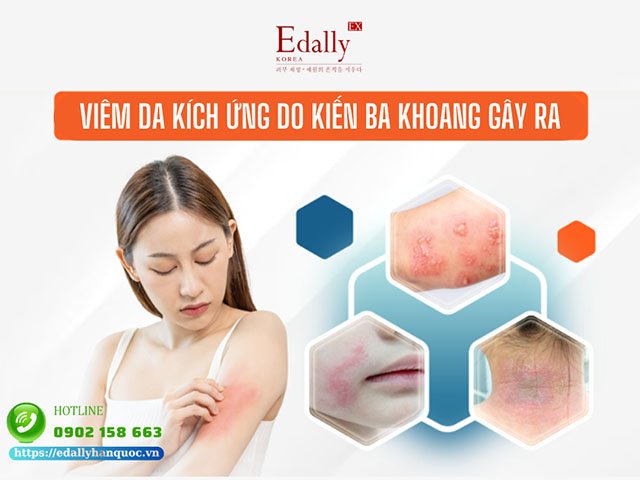 Viêm da tiếp xúc kích ứng do kiến ba khoang và cách xử lý