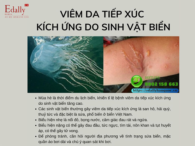 Viêm da tiếp xúc kích ứng do sinh vật biển là bệnh lý ngoài da thường gặp vào mùa hè