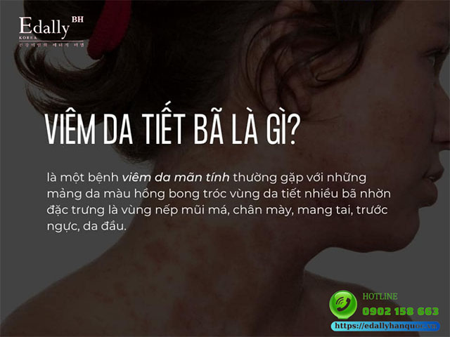 Viêm da tiết bã nhờn là gì?