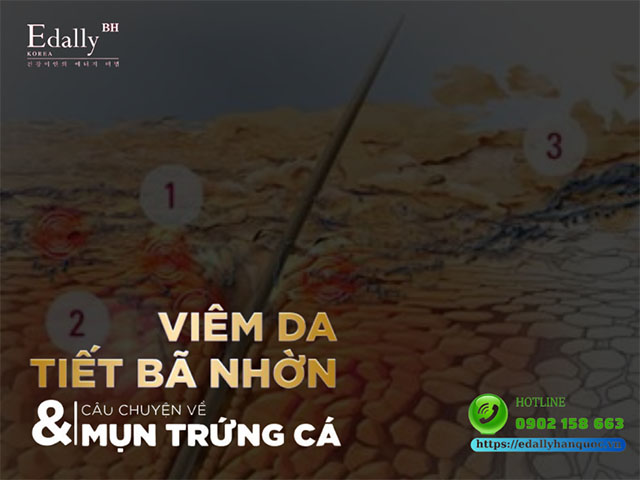 Viêm da tiết bã nhờn và câu chuyện về mụn trứng cá