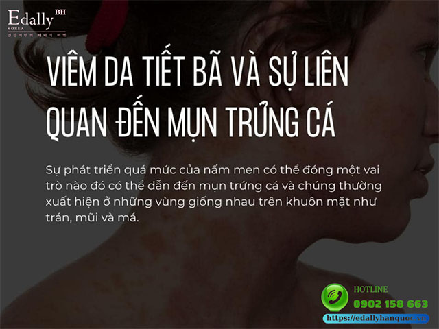 Viêm da tiết bã nhờn có liên quan gì đến mụn trứng cá?