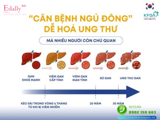 Viêm gan B là căn bệnh ngủ đông dễ hóa ung thư gan mà nhiều người còn chủ quan