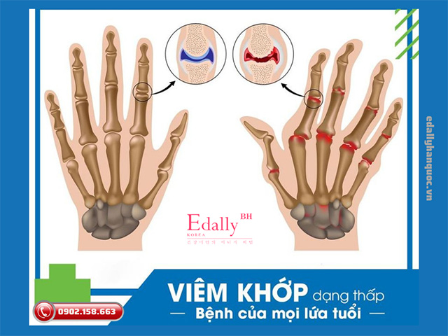 Viêm khớp dạng thấp - Bệnh của mọi lứa tuổi