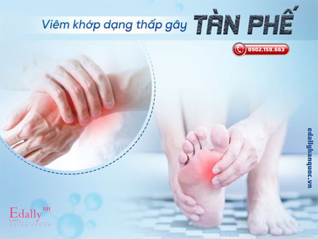 Viêm khớp dạng thấp là bệnh lý cơ xương khớp có biến chứng nguy hiểm có thể gây tàn phế