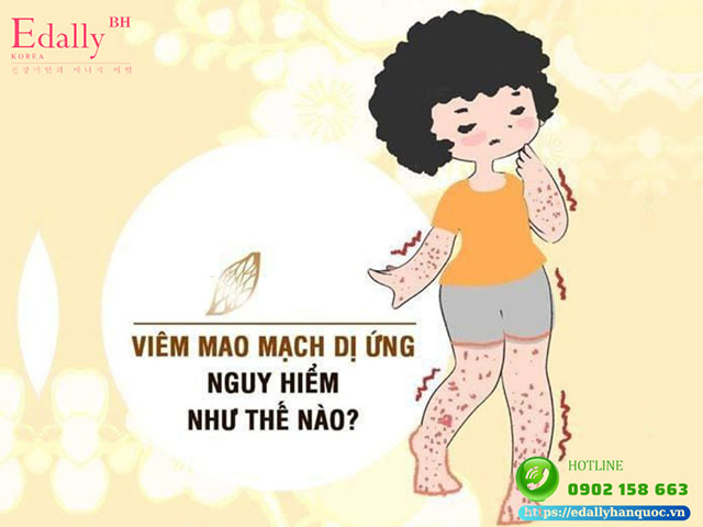 Viêm mao mạch dị ứng có nguy hiểm không và có chữa khỏi được không?