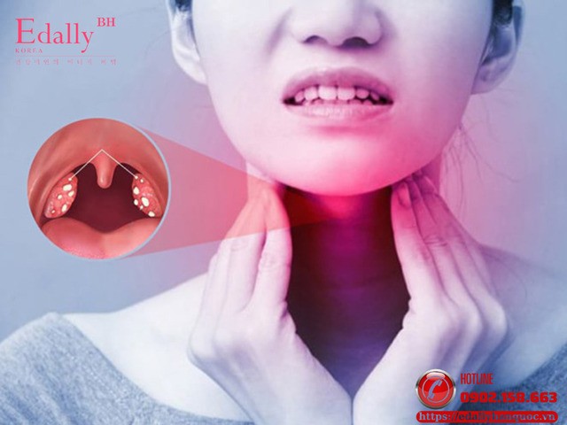 Viêm mũi họng cấp tính: Điều trị kết hợp đông - tây y Viêm mũi họng cấp tính: Điều trị kết hợp đông - tây y