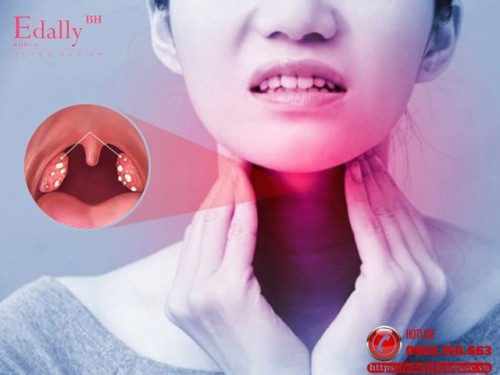 Viêm Mũi Họng Cấp Tính: Điều Trị Kết Hợp Đông - Tây Y Viêm Mũi Họng Cấp Tính: Điều Trị Kết Hợp Đông - Tây Y