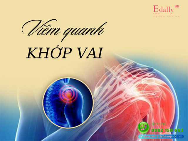 Viêm quanh khớp vai: Nguyên nhân, triệu chứng và cách điều trị