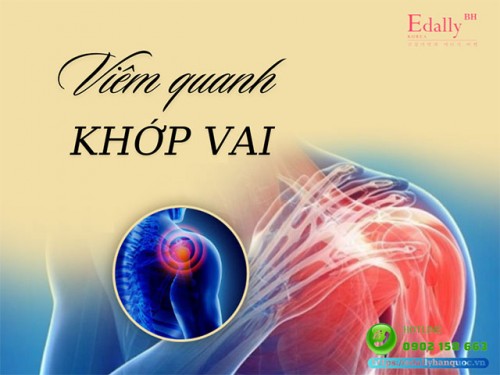 Viêm Quanh Khớp Vai: Nguyên Nhân, Triệu Chứng, Cách Điều Trị