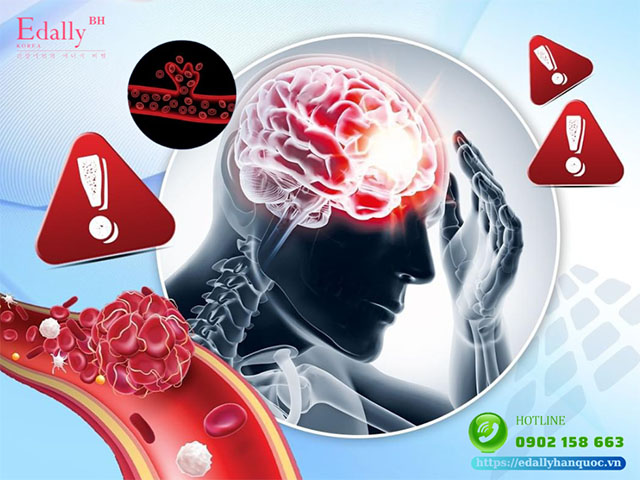 Vỡ mạch máu não: Nguyên nhân, triệu chứng và cách điều trị, phòng ngừa hiệu quả
