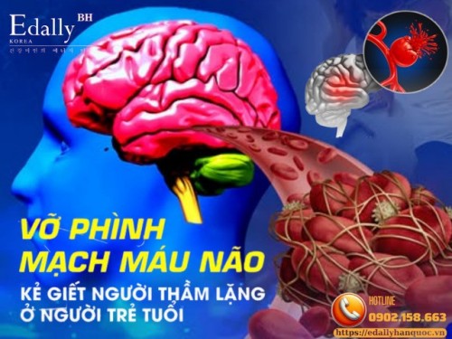 Vỡ Phình Mạch Máu Não - Nguyên Nhân Tử Vong Ở Người Trẻ Tuổi 