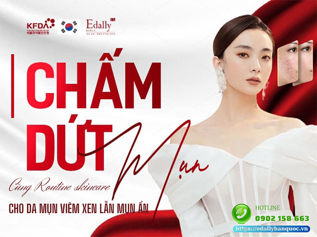 Xếp routine skincare cho da mụn viêm xen lẫn mụn ẩn