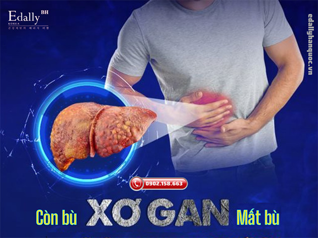 Bệnh xơ gan được phân chia cở bản làm 2 loại là xơ gan còn bù và xơ gan mất bù (xơ gan cổ trướng)