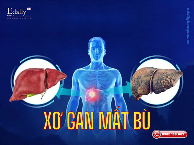 Bệnh xơ gan mất bù hay còn gọi là bệnh xơ gan cổ trướng