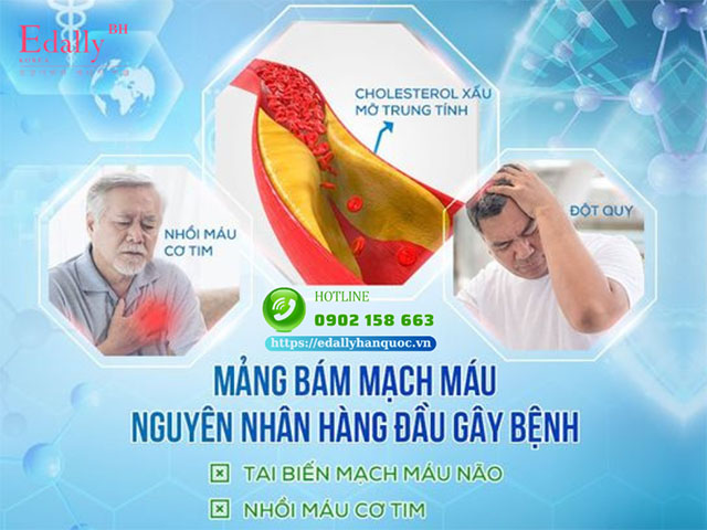 Bệnh xơ vữa động mạch là nguyên nhân hàng đầu gây bệnh tai biến mạch máu não và nhồi máu cơ tim