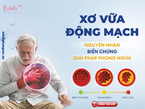 Bệnh Xơ Vữa Động Mạch - Nguyên Nhân, Triệu Chứng, Cách Điều Trị