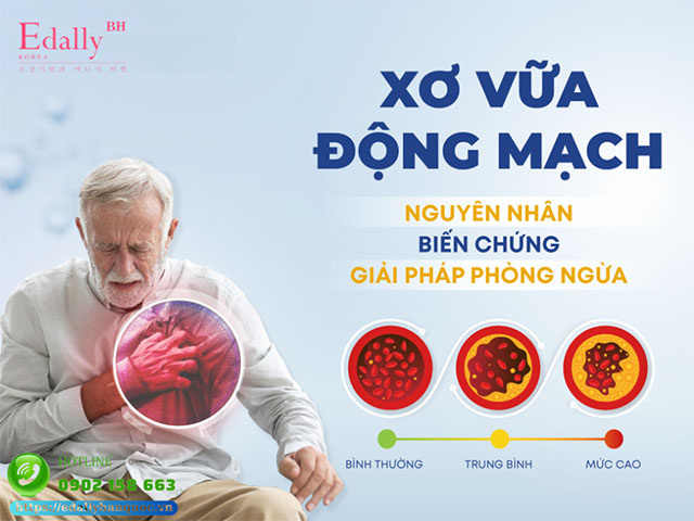 Xơ vữa động mạch - Những điều cần biết để phòng ngừa hiệu quả