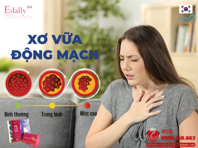 Xơ vữa động mạch sau mãn kinh làm tăng nguy cơ nhồi máu cơ tim và đột quỵ