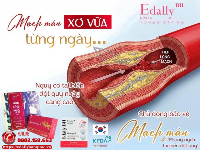 Xơ vữa mạch máu là nguyên nhân dẫn đến đột quỵ