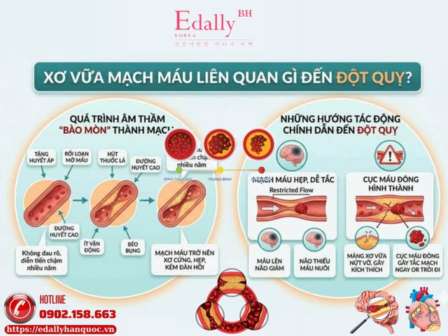 Xơ vữa mạch máu liên quan gì đến đột quỵ?