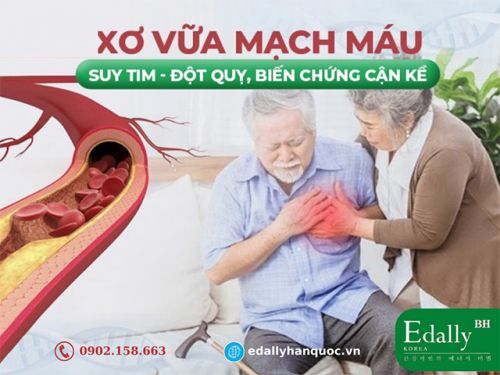 Xơ Vữa Mạch Máu Nguy Hiểm Như Thế Nào?