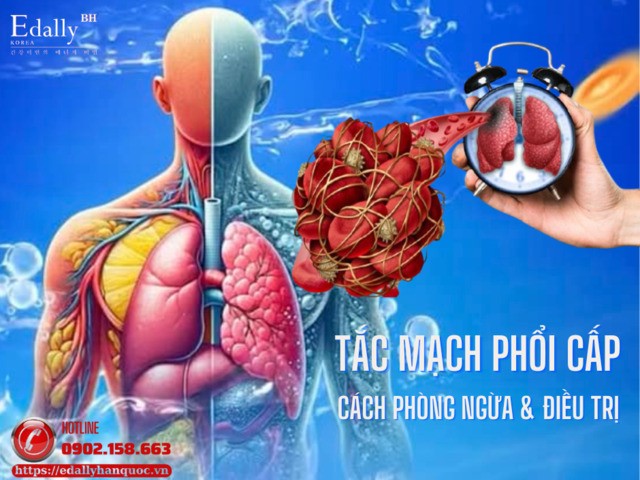 Xử Trí Thuyên Tắc Phổi Cấp (PE) Theo AHA/ACC 2026
